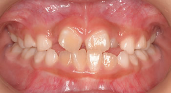 子どもの歯並び